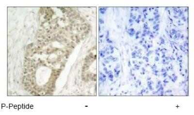 Immunohistochemistry-Paraffin: PKC delta [p Ser645] Antibody [NB100-82141] - Immunohistochemical analysis of paraffin-embedded human breast carcinoma tissue using NB100-82141 (left) or the same antibody preincubated with blocking peptide(right).